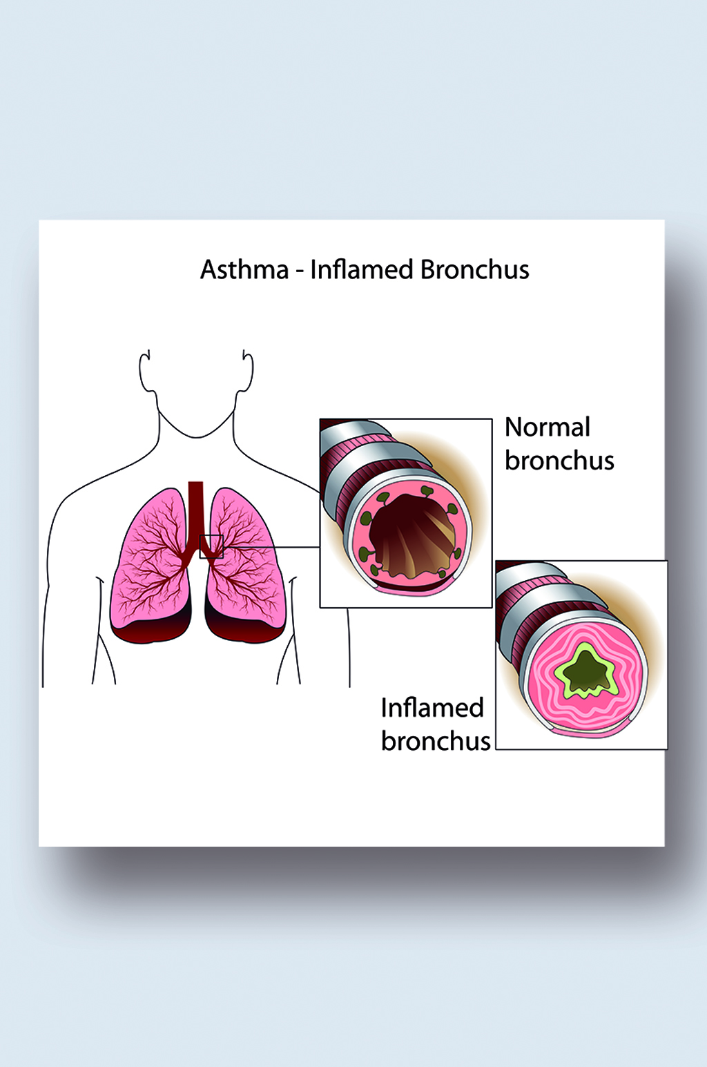 支气管哮喘病症解析图医学器官解剖插图