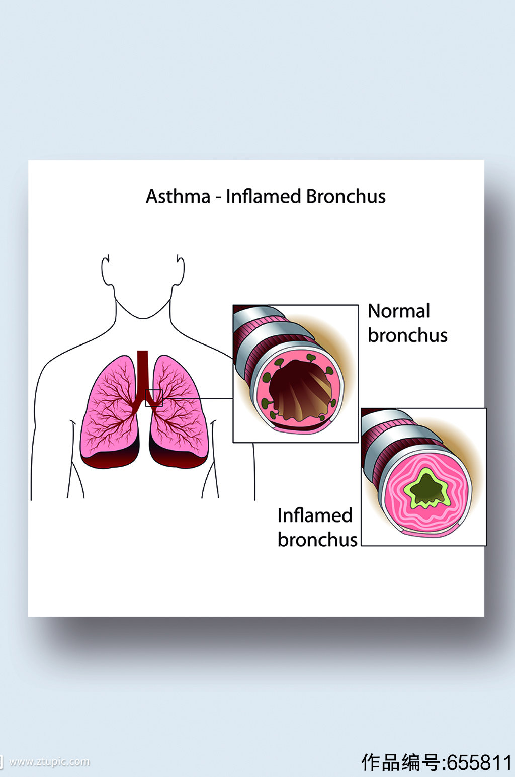 支气管哮喘病症解析图医学器官解剖插图