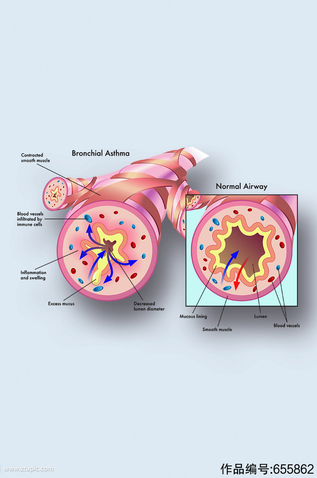 支气管哮喘病症解析图医学器官解剖插图