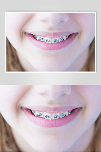 牙套示范 医疗牙科图片