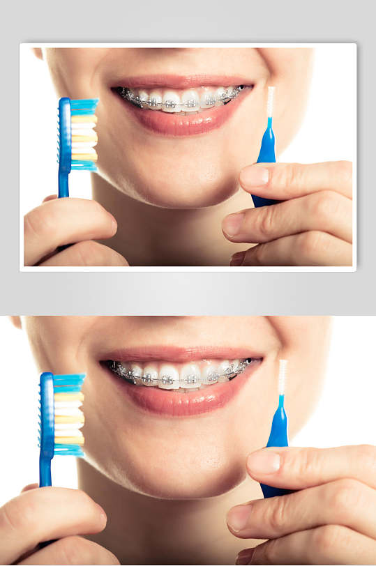 牙套图片