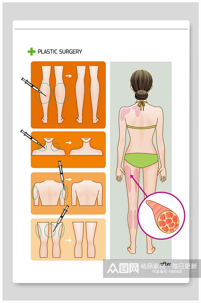 医美整形矢量素材抽脂细腿瘦肩素材