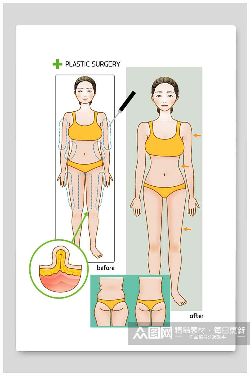 医美整形矢量素材瘦腿抽脂素材