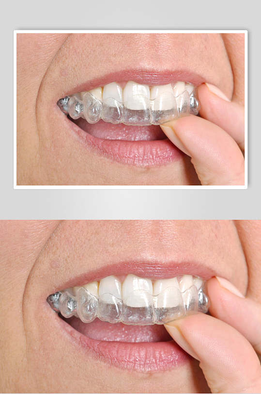 美白健齿牙套牙齿矫正图片