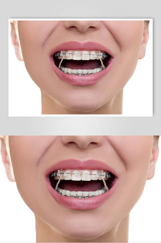 口腔矫正图片-口腔矫正素材下载-众图网