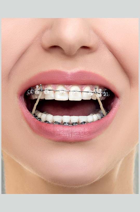 口腔健康牙套牙齿矫正图片