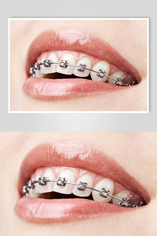 口腔健康牙套牙齿矫正图片