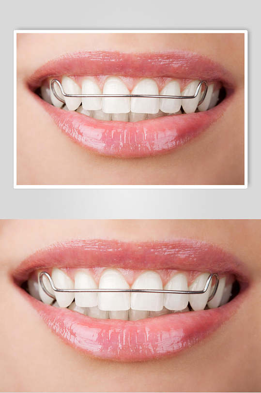 美白健齿牙套牙齿矫正图片