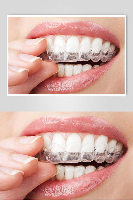 牙套牙齿矫正图片