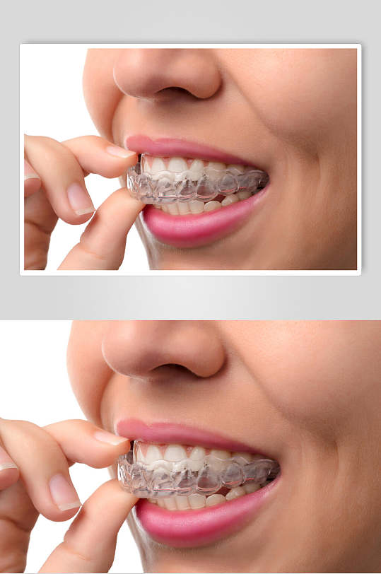 隐形牙齿图片-隐形牙齿素材下载-众图网