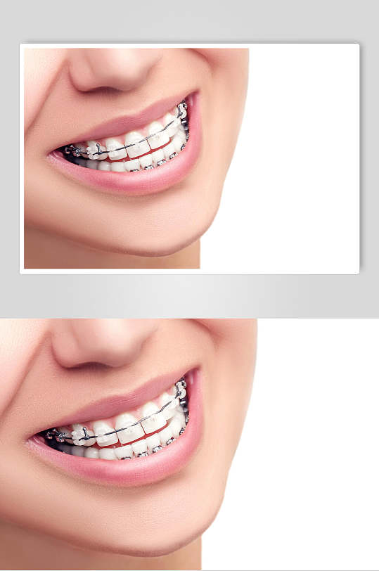 口腔健康牙套牙齿矫正图片