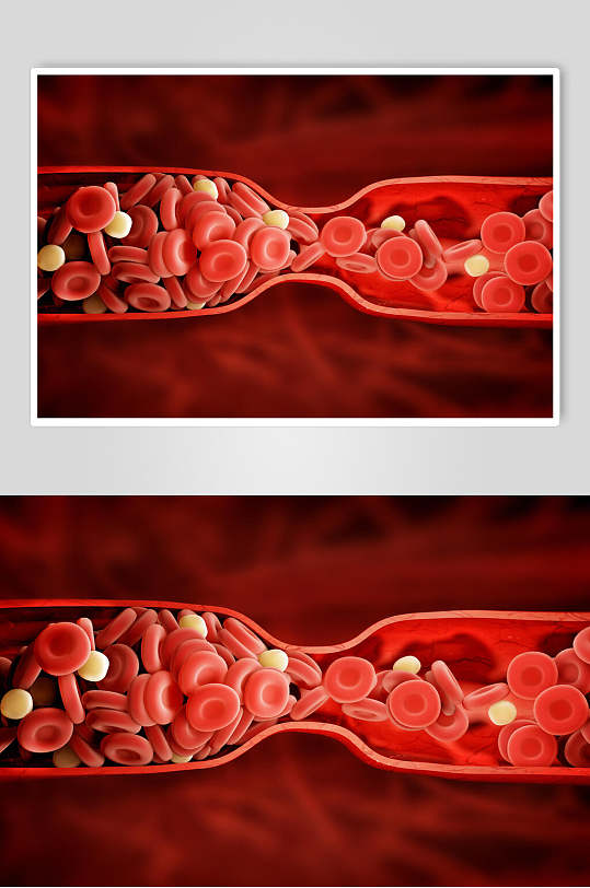 血管堵塞细胞病菌图片