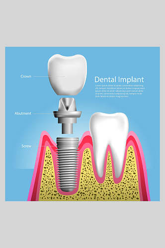 英文简约清新器皿科普牙齿植牙矢量图解插画