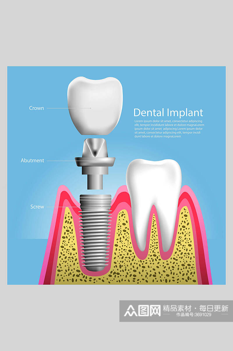英文简约清新器皿科普牙齿植牙矢量图解插画素材