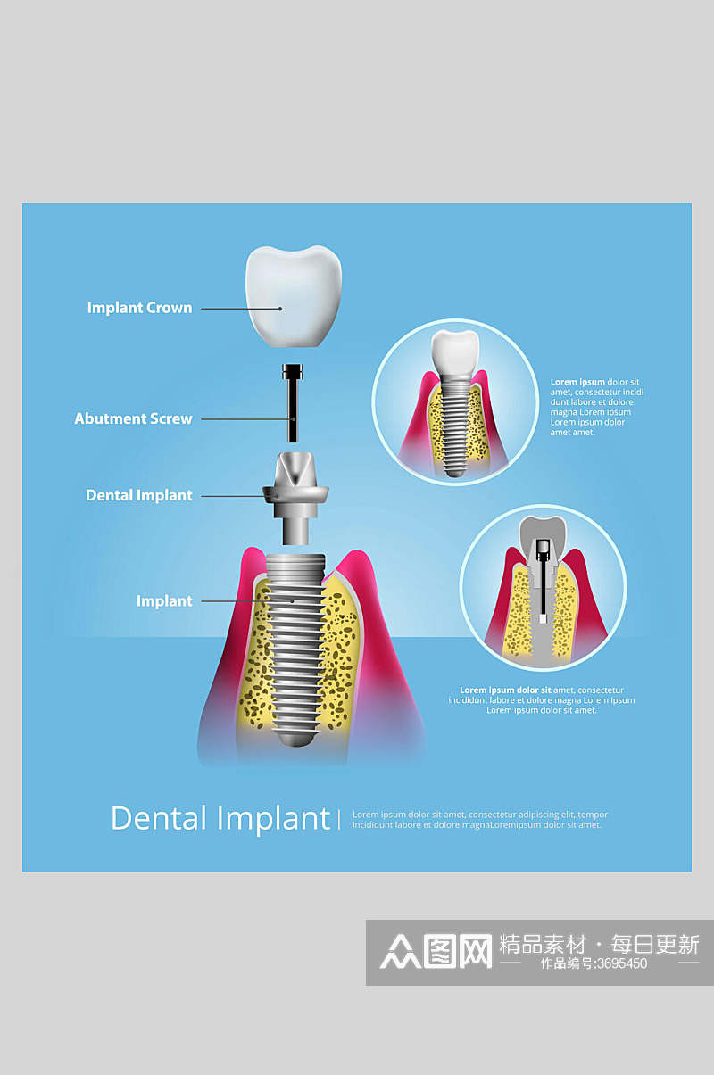 大气创意牙齿植牙矢量图解插画素材