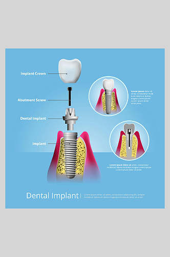 大气创意牙齿植牙矢量图解插画