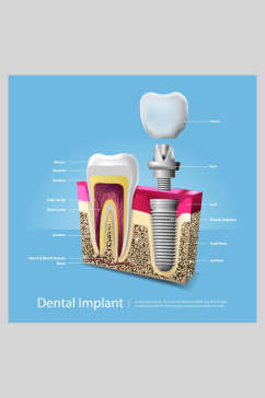 蓝色创意牙齿植牙矢量图解插画