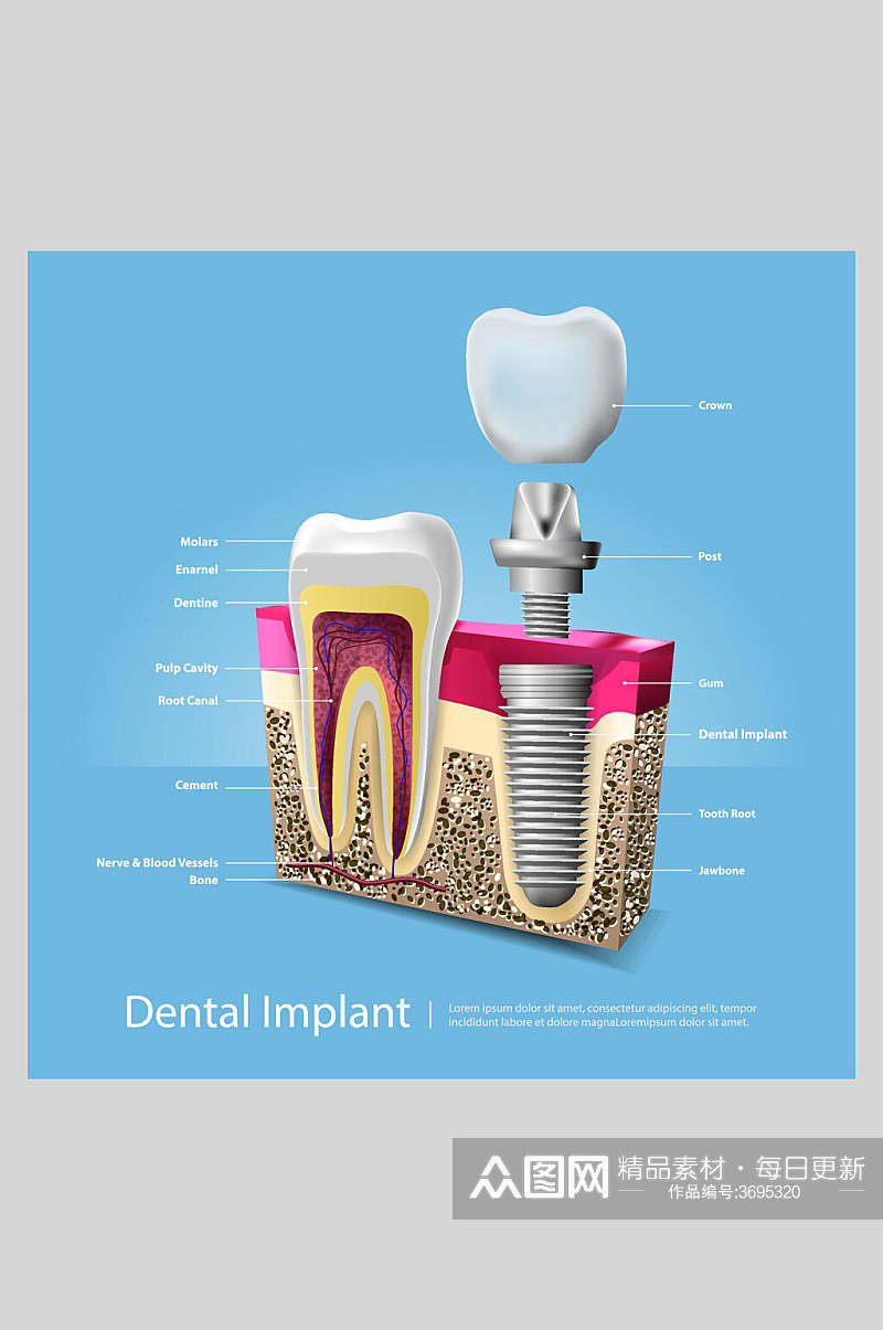 蓝色创意牙齿植牙矢量图解插画素材