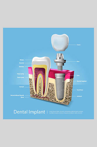 蓝色创意牙齿植牙矢量图解插画