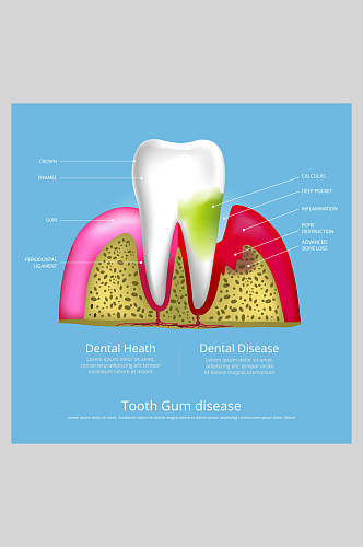 简约蓝色牙齿植牙矢量图解插画