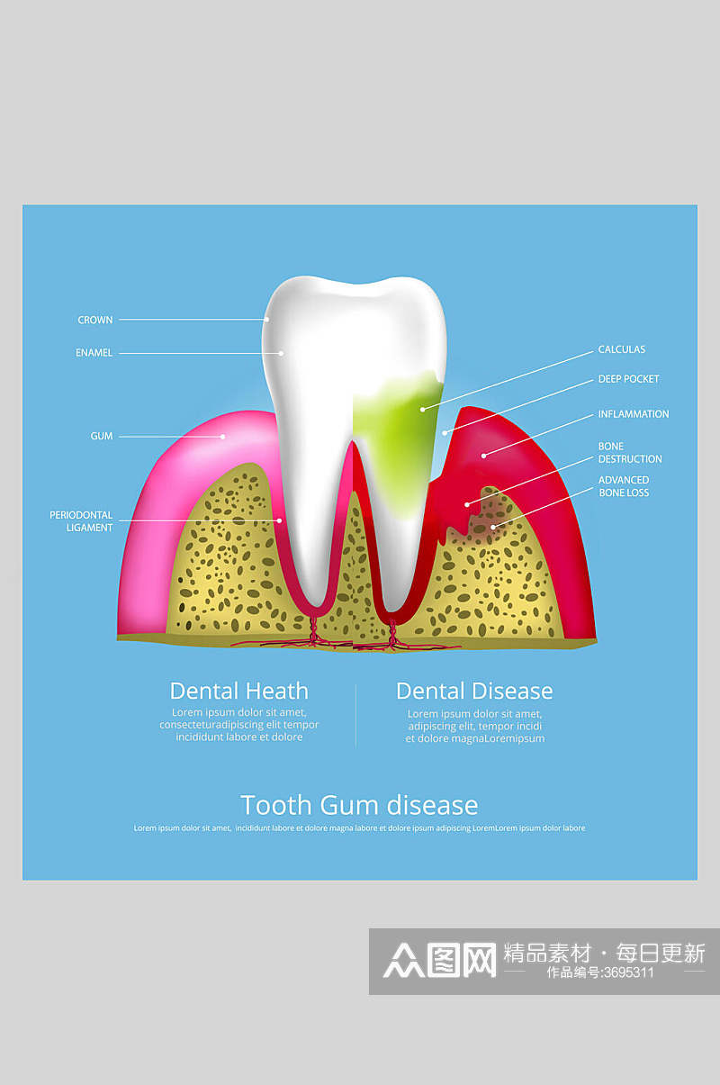 简约蓝色牙齿植牙矢量图解插画素材