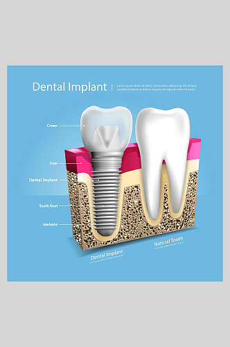 蓝色大气时尚牙齿植牙矢量图解插画