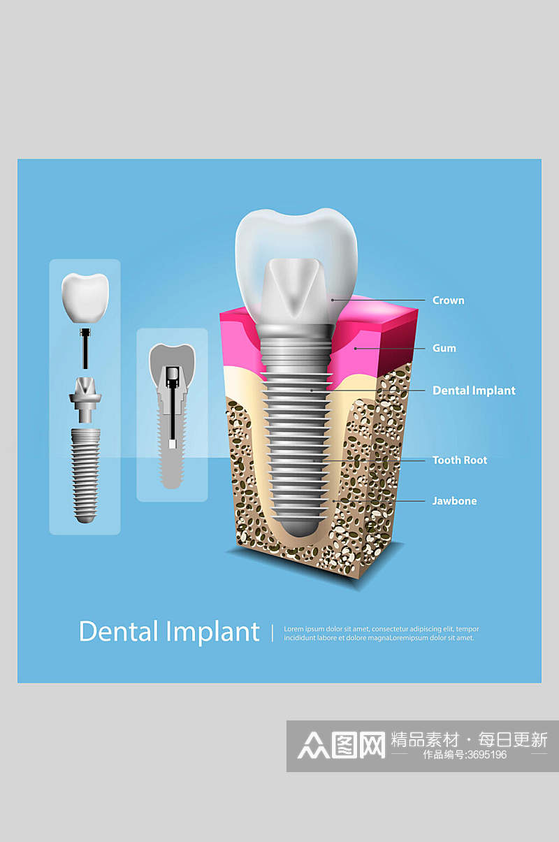 蓝色大气创意牙齿植牙矢量图解插画素材