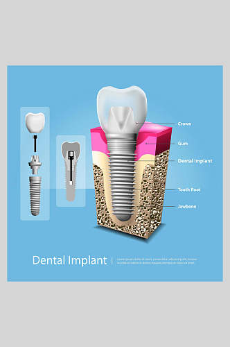 蓝色大气创意牙齿植牙矢量图解插画