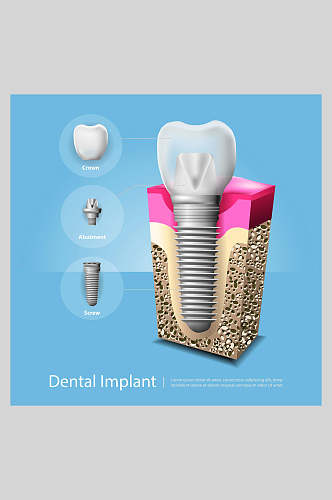 高端时尚牙齿植牙矢量图解插画
