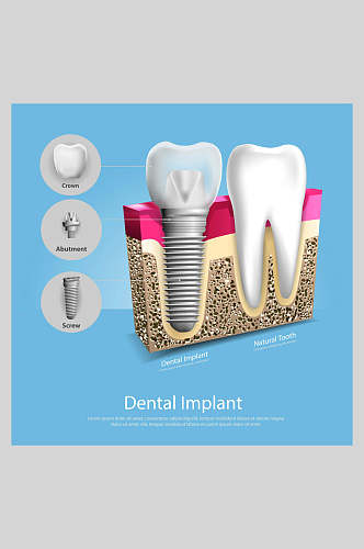 蓝色大气牙齿植牙矢量图解插画