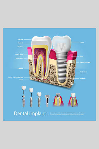 蓝色大气英文牙齿植牙矢量图解插画