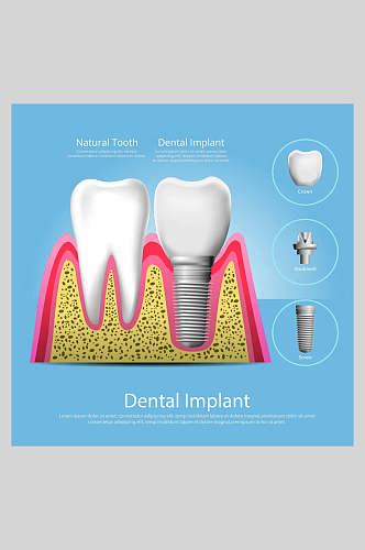 蓝色牙齿植牙矢量图解插画