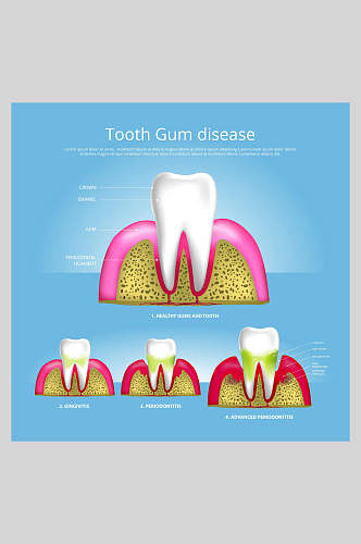 创意高端大气牙齿植牙矢量图解插画