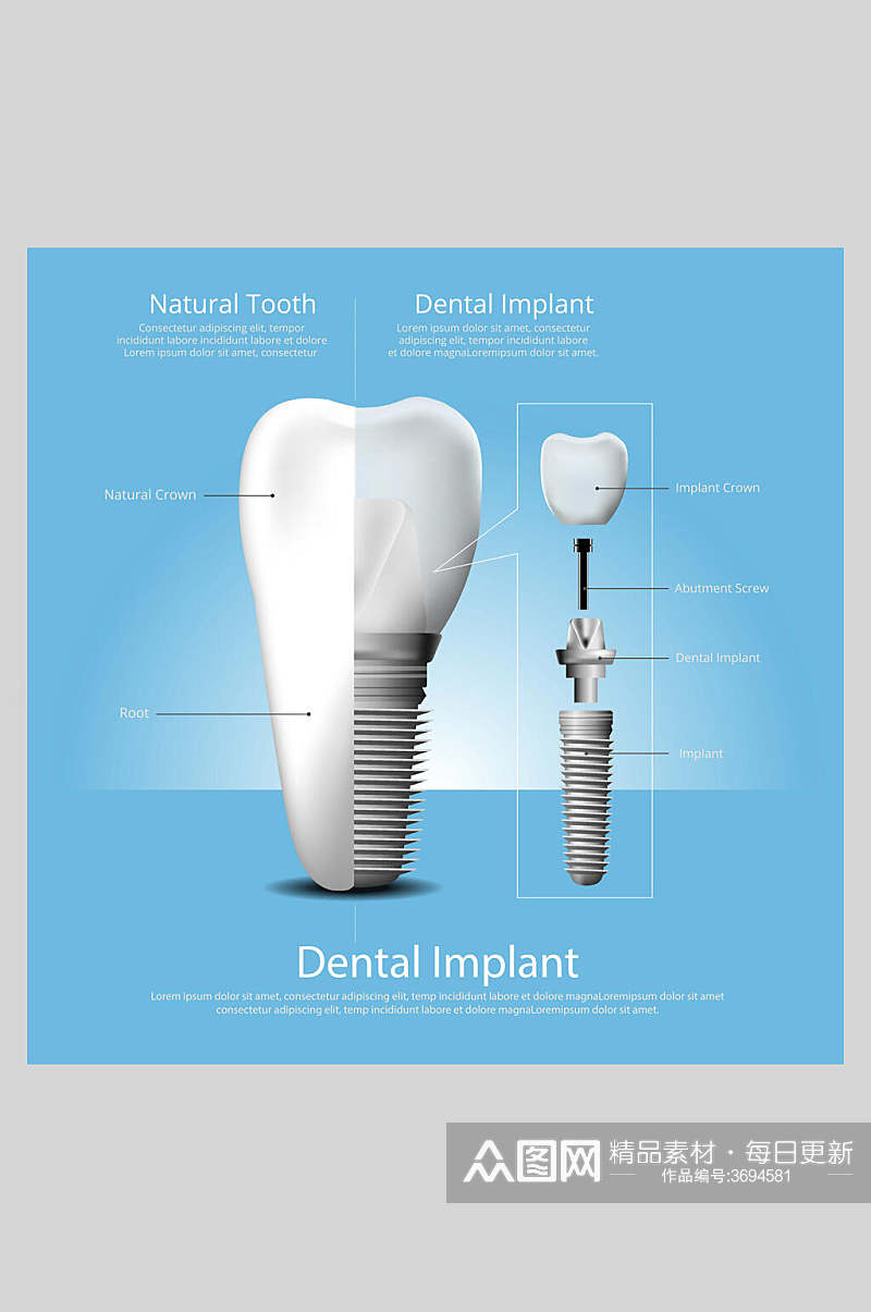 蓝色创意牙齿植牙矢量图解插画素材