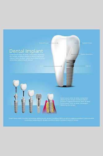 蓝色英文牙齿植牙矢量图解插画