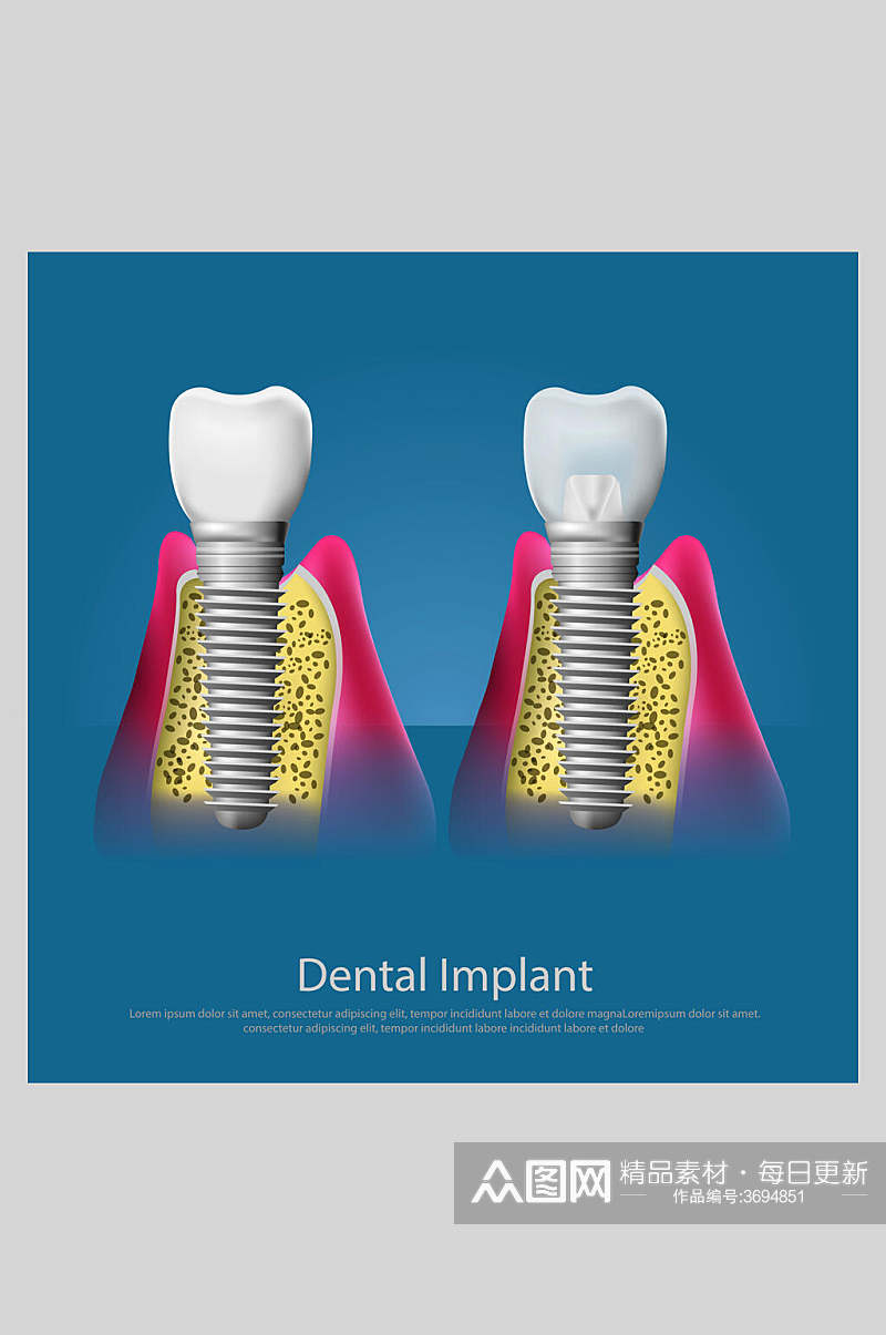 蓝色牙齿植牙矢量图解插画素材