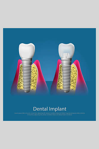 蓝色牙齿植牙矢量图解插画