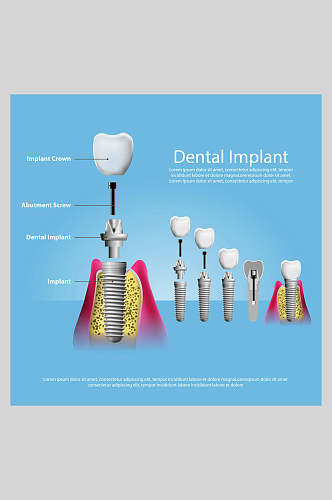 蓝色英文牙齿植牙矢量图解插画