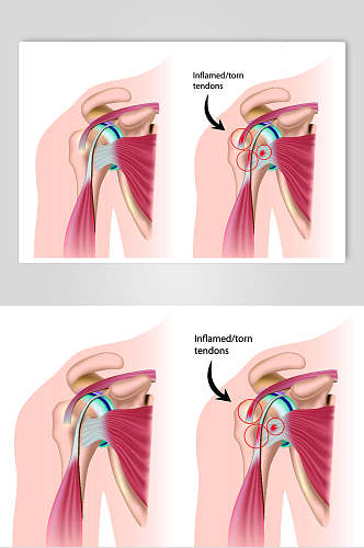 肩膀器官医疗医学人体解剖矢量素材