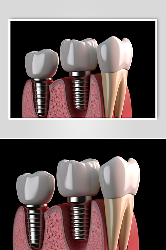 AI数字艺术医疗牙齿模型