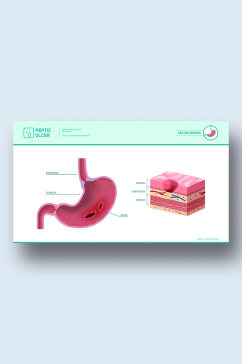 胃溃疡病症解析图医学器官解剖插图
