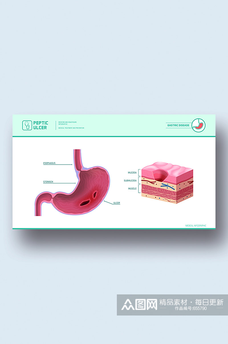 胃溃疡病症解析图医学器官解剖插图素材