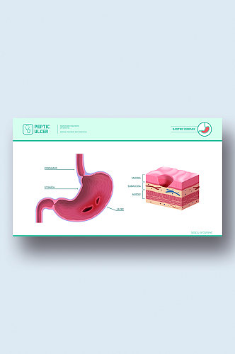 胃溃疡病症解析图医学器官解剖插图