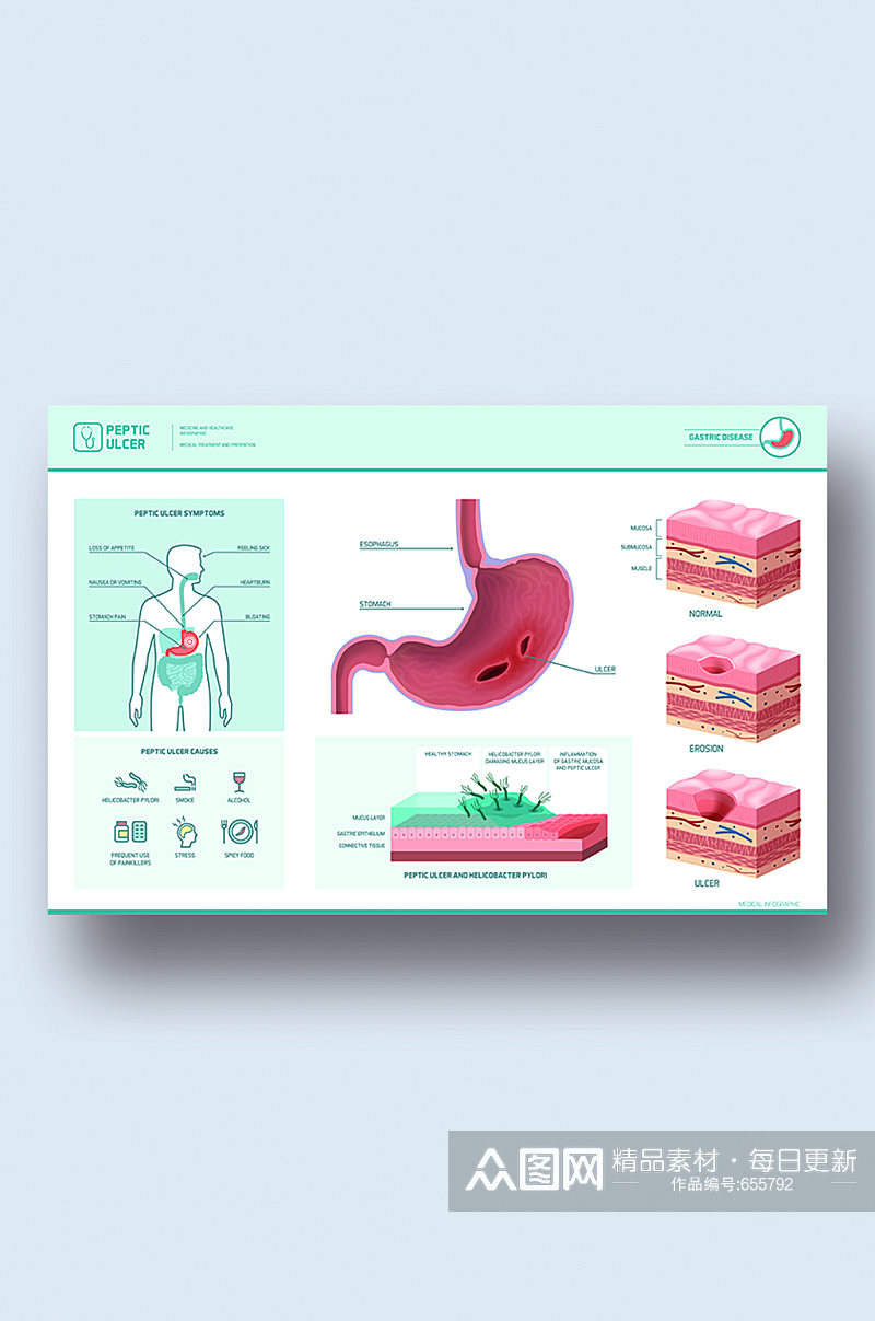 胃溃疡病症解析图医学器官解剖插图素材