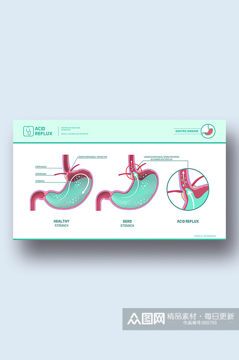 胃反流图病症解析图医学器官解剖插图素材