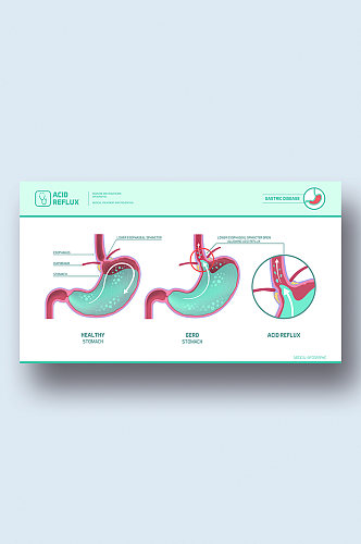 胃反流图病症解析图医学器官解剖插图