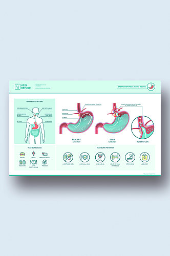 胃食管反流病症解析图医学器官解剖插图