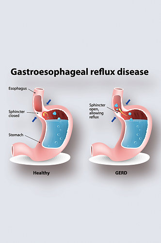 胃食管返流病病症解析图医学器官解剖插图