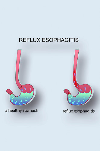 食管炎医学人体器官组织解剖插图元素