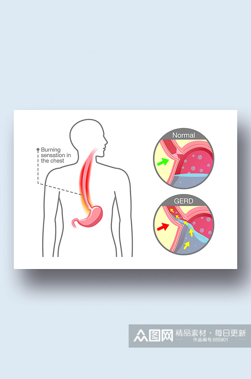 胃酸胃食管反流病症解析图医学器官解剖插图素材